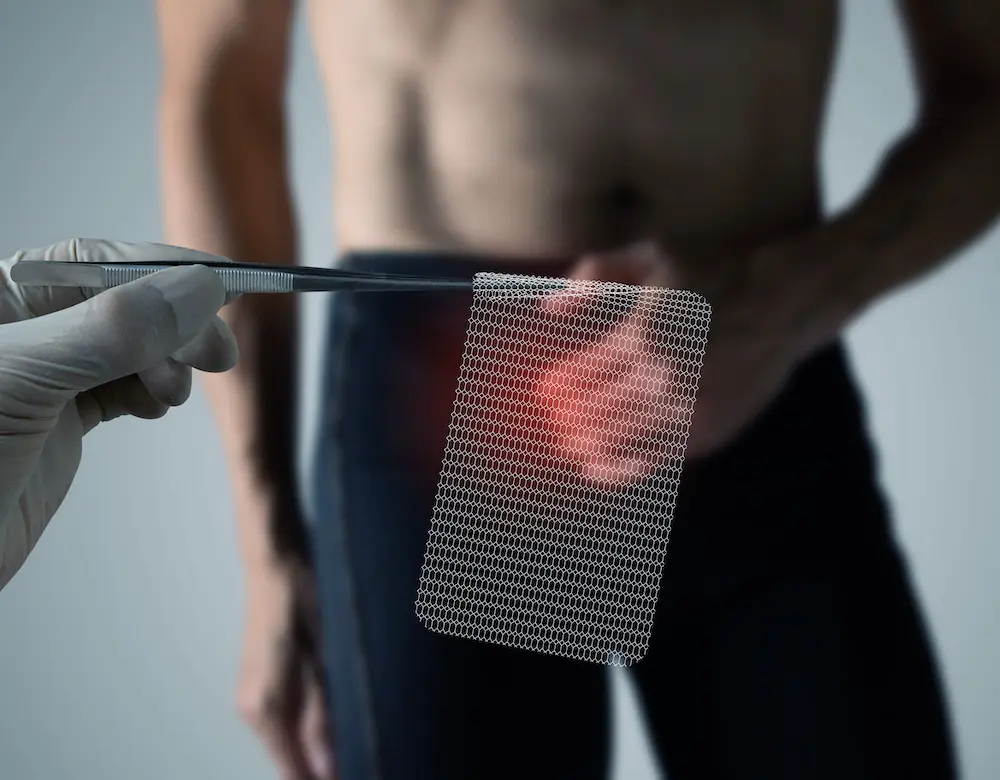 Leistenbruchchirurgie